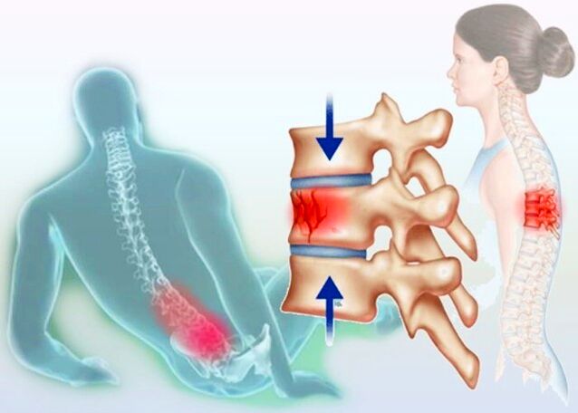 Pat parasta trauma var izraisīt osteohondrozes attīstību