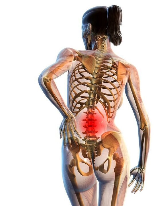 Visbiežāk rodas mugurkaula jostas daļas osteohondroze