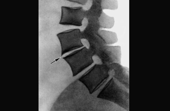 Mugurkaula krūšu kurvja osteohondrozes izpausmes rentgenā
